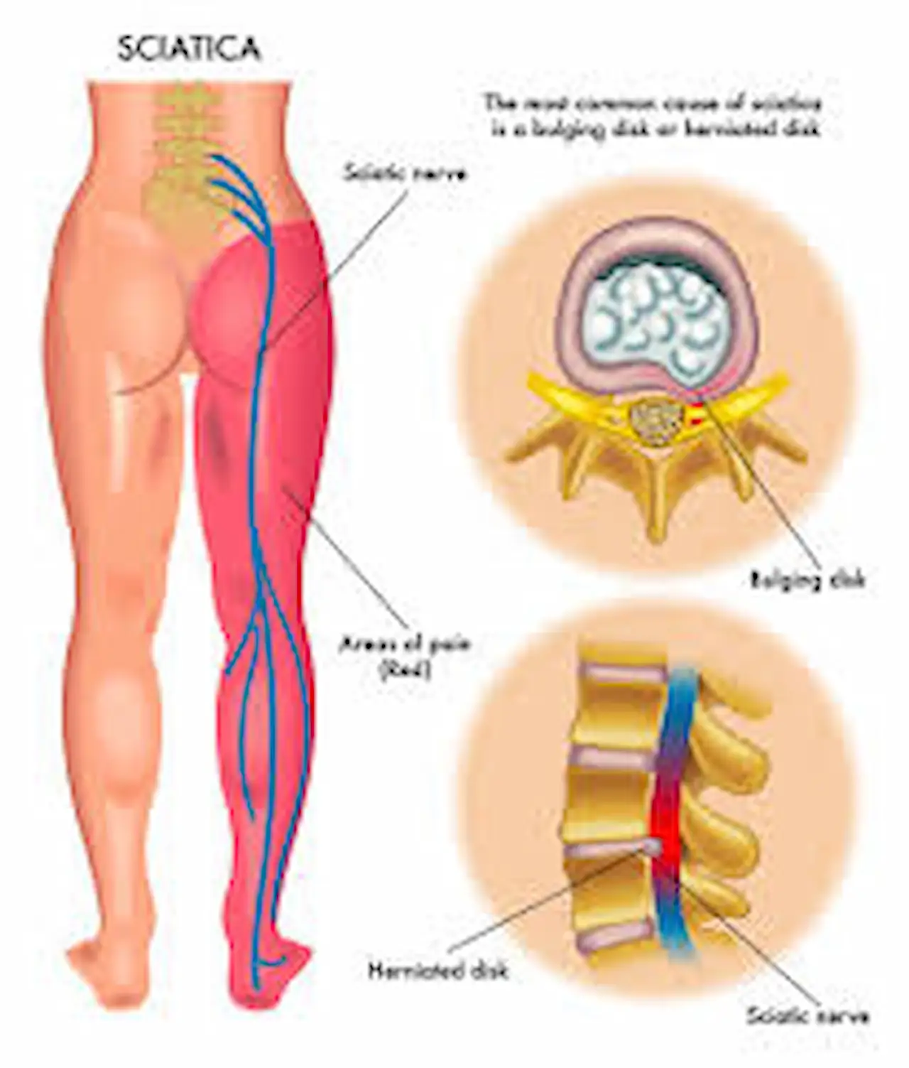 Home remedies for sciatica