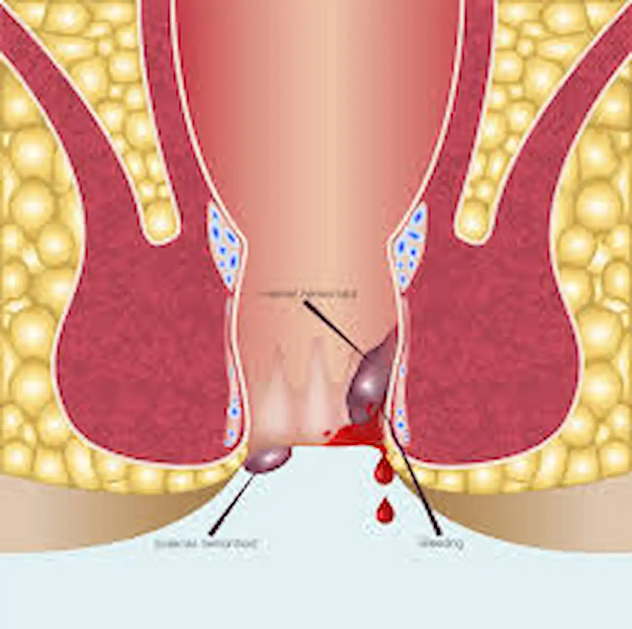 home remedies for piles