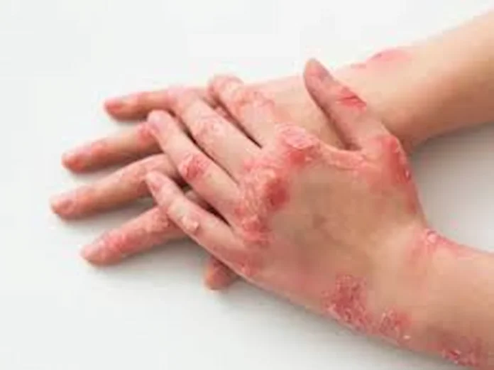 Home remedies for skin disease