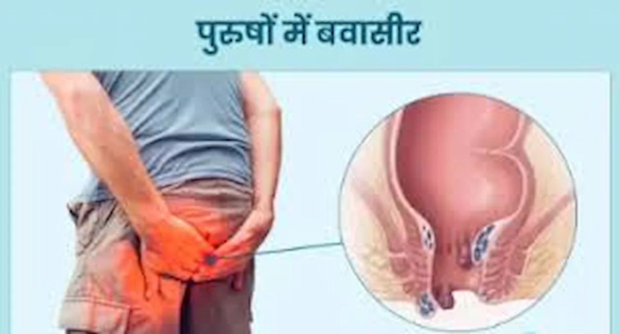Home remedies for piles