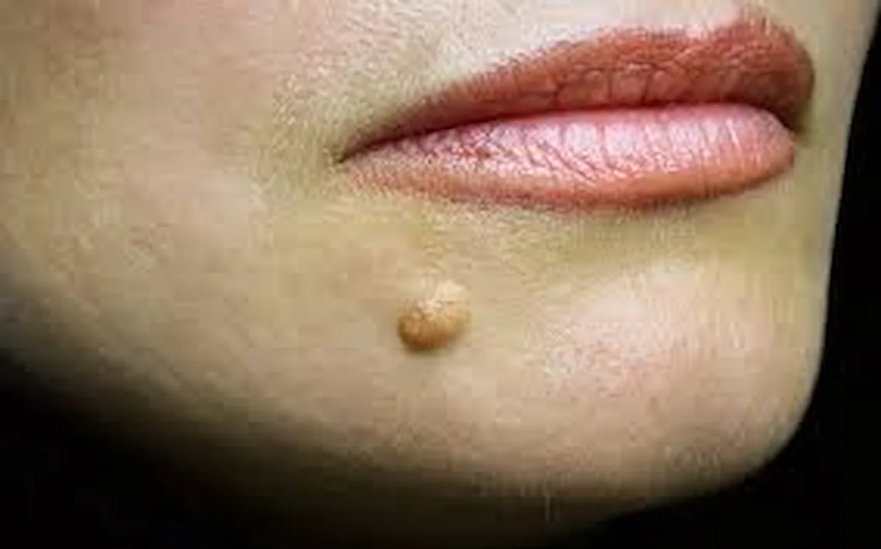 home remedies for warts
