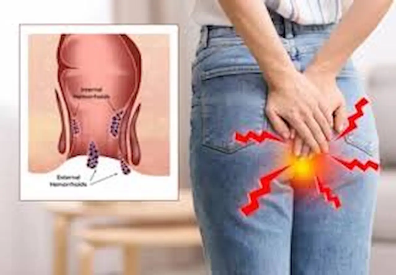 Home remedies for piles