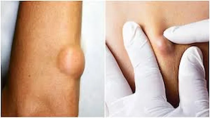 home remedies for lump in body 