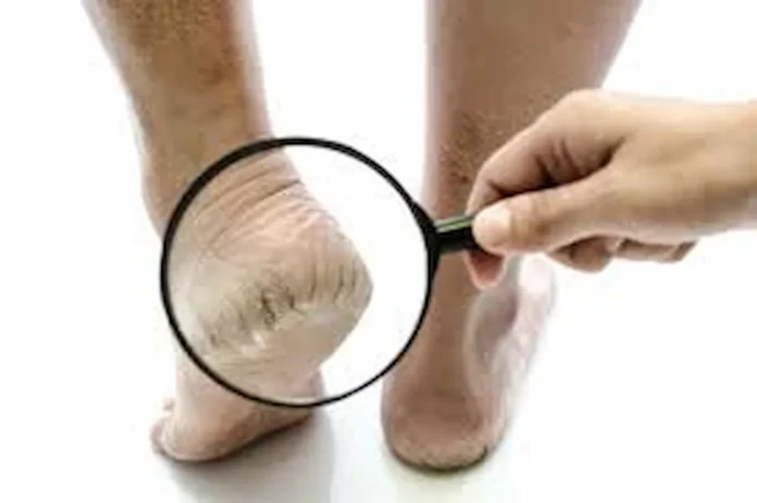 home remedies for cracked heels 