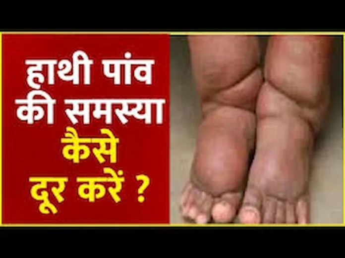home remedies for elephantiasis