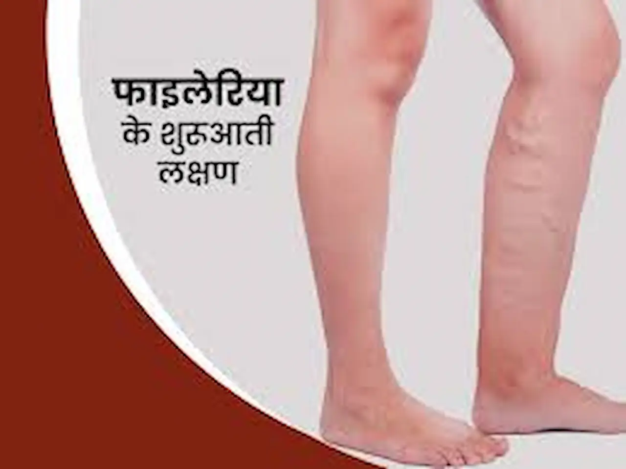 home remedies for elephantiasis