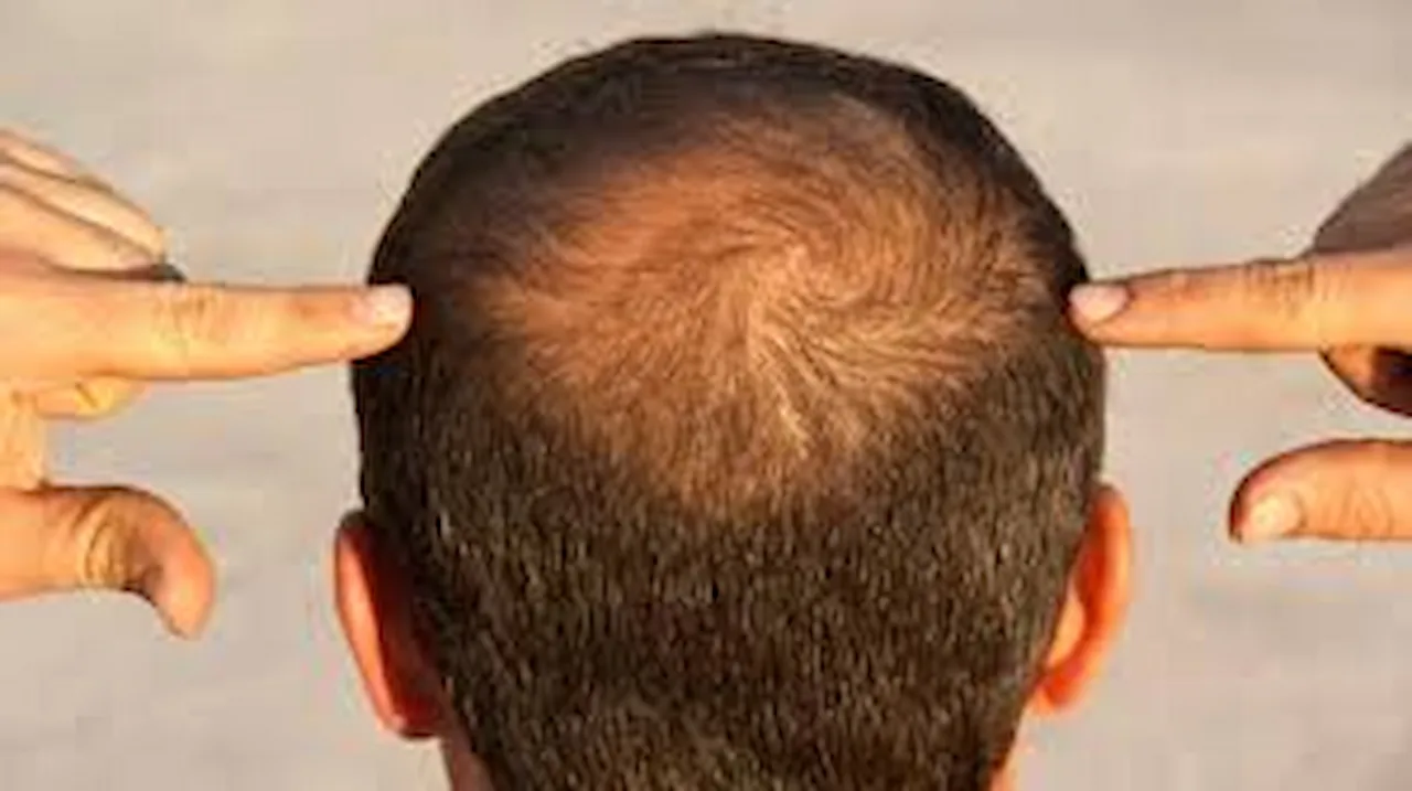 home remedies for hair loss 